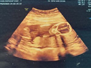 Ultrasound of bub number 2